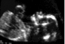 Ultrasound image of a baby